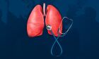 Biomarcador se mostra capaz de agir contra câncer pulmonar agressivo