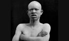 Dia de conscientização alerta sobre preconceito contra albinismo
