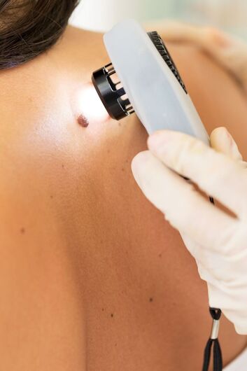 Empresas desenvolvem vacina de RNA contra câncer de pele tipo melanoma - 