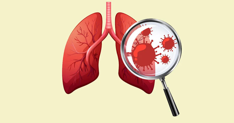 A tuberculose pulmonar totaliza 70% dos casos da doença e apresenta sintomas como tosse, febre e emagrecimento - Crédito: Freepik