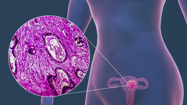 HPV pode causar câncer de colo de útero    - Crédito: Getty Images