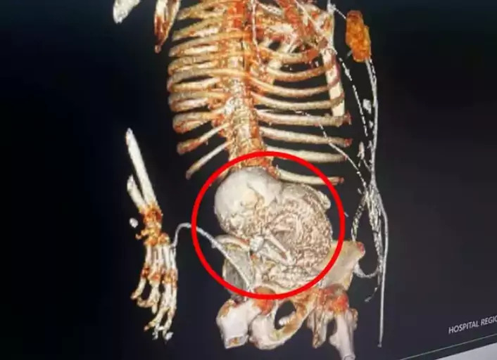 Mulher descobre feto mumificado na barriga: 'grávida há 56 anos' - 