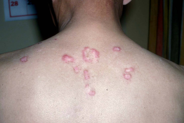Lupus caracteriza-se pelo aparecimento de manchas avermelhadas. - Crédito: Foto: Divulgação