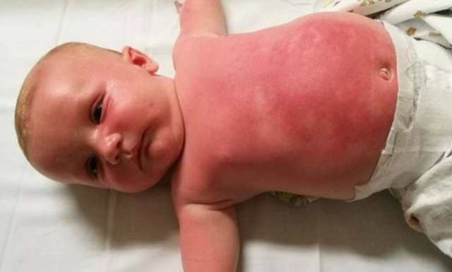 Bebê é internado na Austrália após uso de protetor solar - 