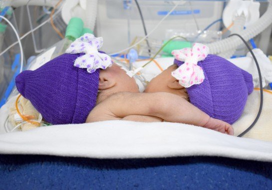 Gêmeas que nasceram ligadas pelo tórax morrem depois de 17 dias - Crédito: divulgação Santa Casa